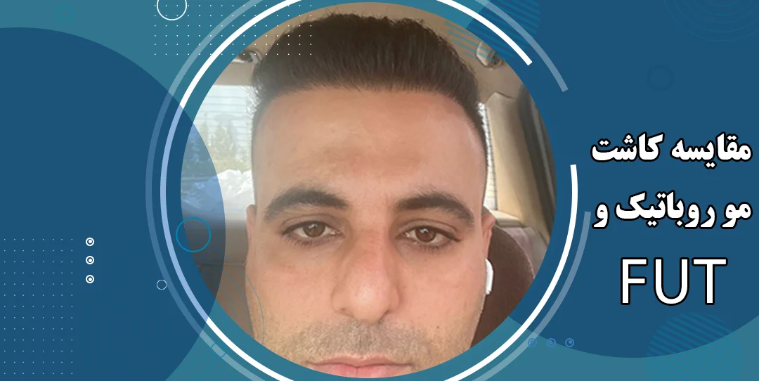 مقایسه کاشت مو روباتیک با fut