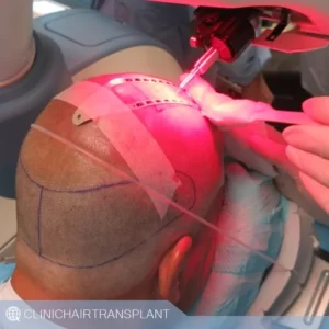 مقایسه کاشت rht با fue