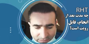 نتیجه کاشت مو RHT