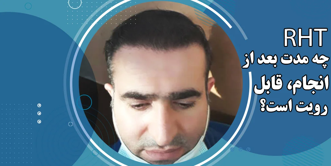 نتیجه کاشت مو RHT