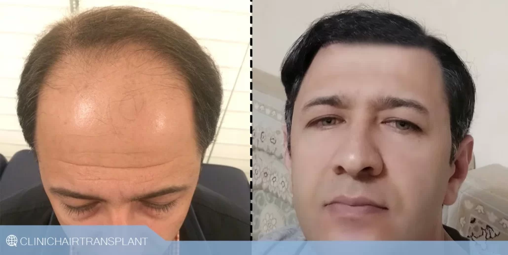 کاشت rht درد دارد؟