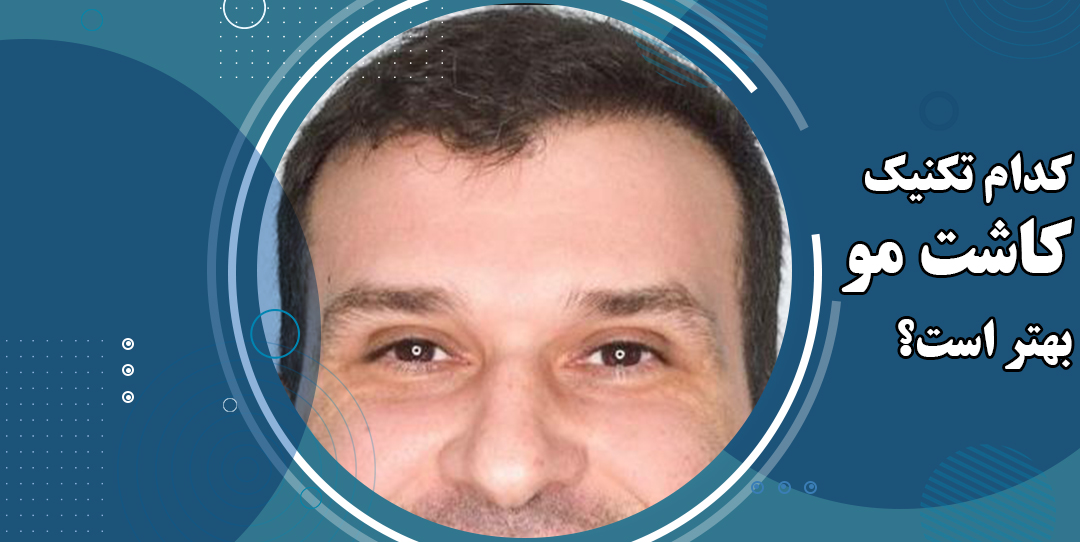 کدام تکنیک کاشت مو بهتر است؟