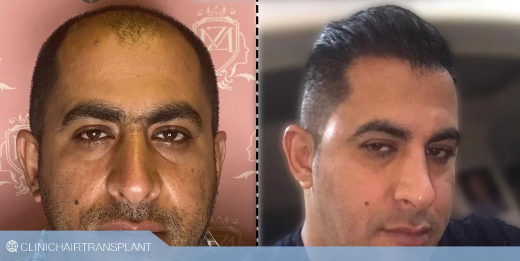 rht طریقه کاشت مو