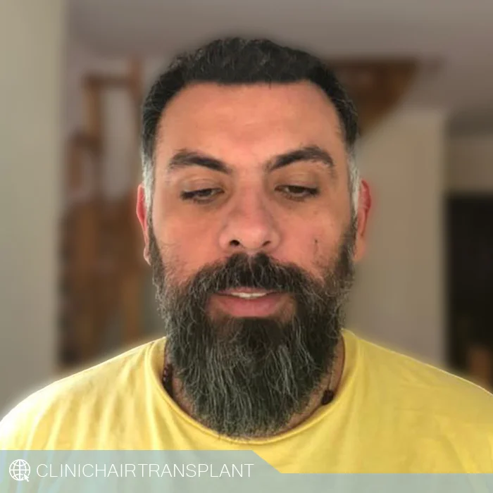 rht مزیت کاشت مو