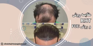 مقایسه کاشت مو به روش RHT و FUE