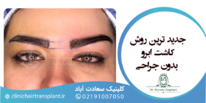 جدیدترین روش کاشت ابرو