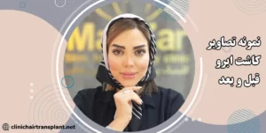 عکس قبل و بعد کاشت ابرو