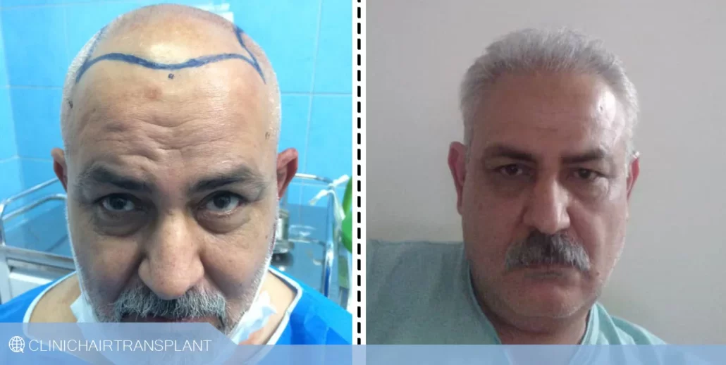 قبل و بعد کاشت مو