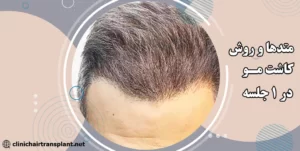 متدهای کاشت مو کدام‌اند؟!