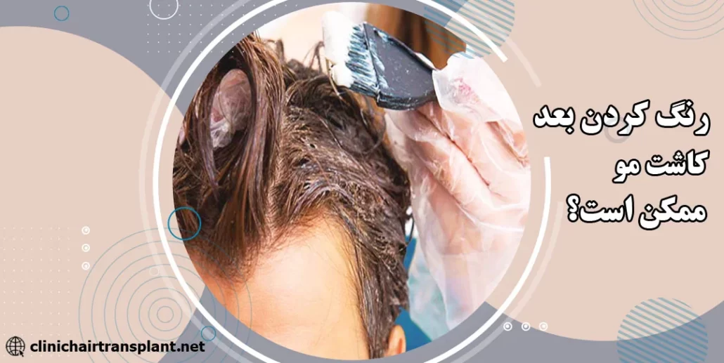 بعد کاشت مو میتوان مو را رنگ کرد؟