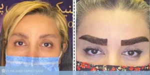نمونه موفق کاشت ابرو