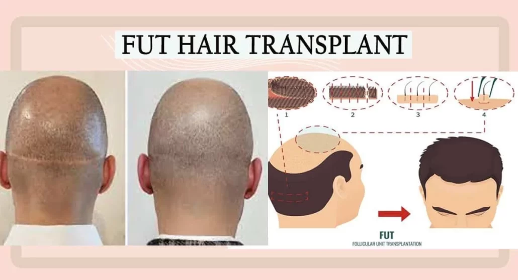 کاشت مو به روش fut