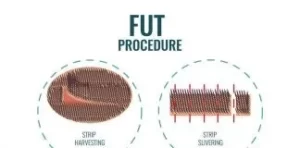 کاشت fut ابرو