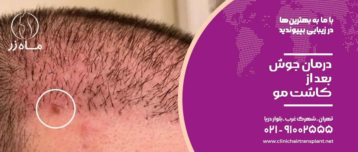 درمان جوش بعد از کاشت مو