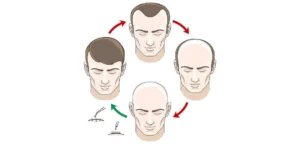 عوامل موثر بر کاشت مو به روش fut