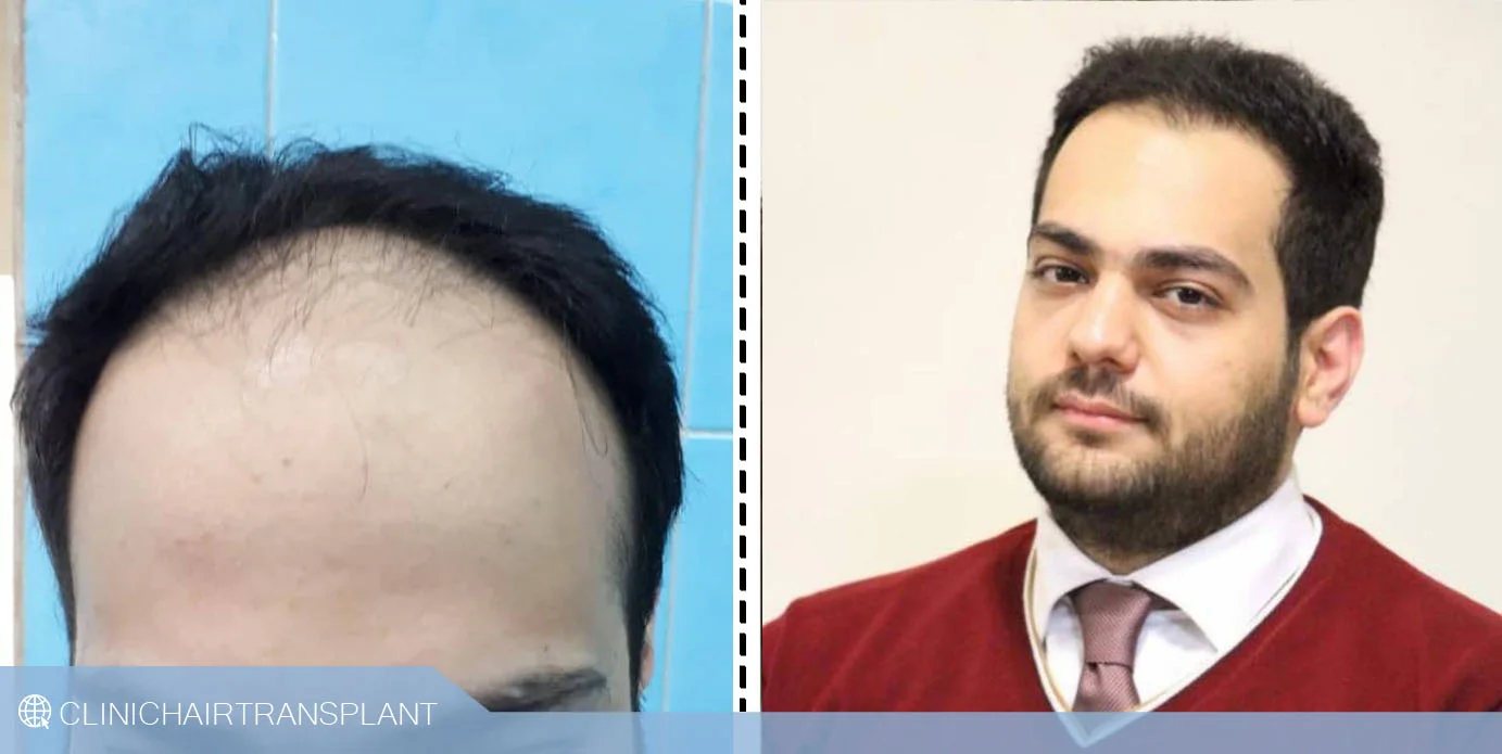 قبل و بعد کاشت مو بدون جوش