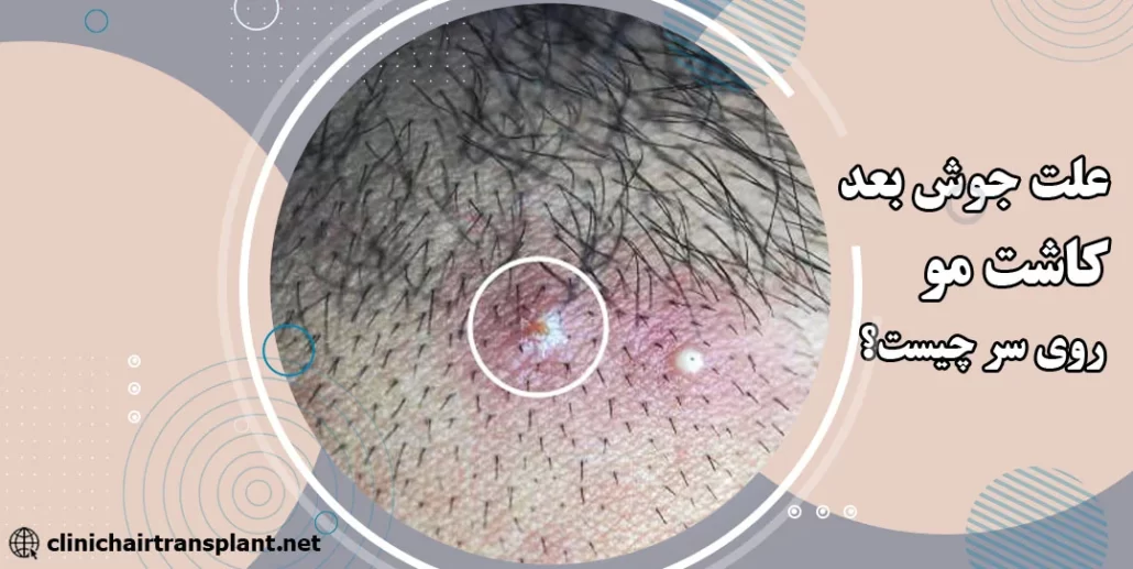 چرا بعد از کاشت مو سر جوش میزند؟
