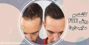 کاشت مو به روش fue معایب دارد؟