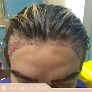 کاشت مو برای زنان بدون عوارض