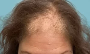 عوارض کاشت مو در زنان چیست؟