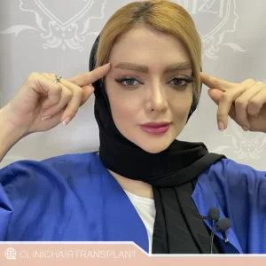 فواید کاشت ابرو بدون جراحی