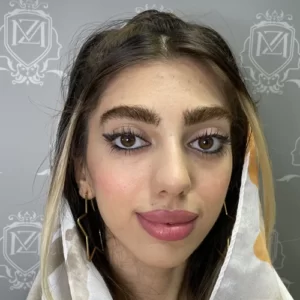 بعد از کاشت ابرو در یک جلسه