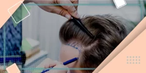 روش استخراج واحد فولیکولی کاشت مو