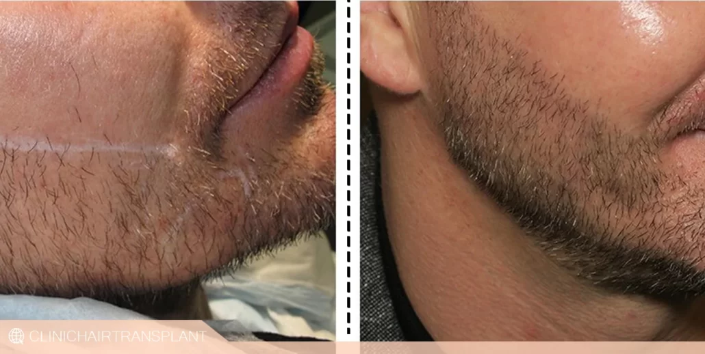عوارض کاشت ریش که موقتی هستند