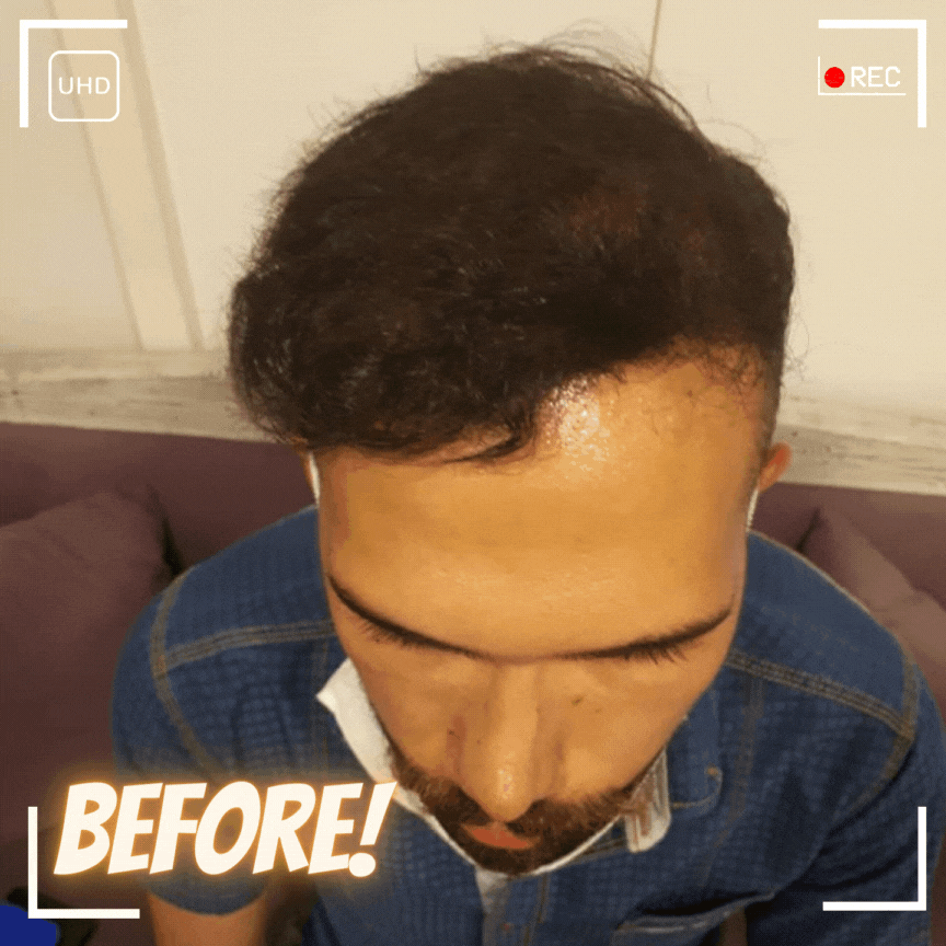 قبل و بعد کاشت fit
