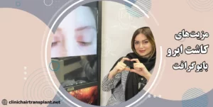 مزایا کاشت ابرو به روش بایوگرافت