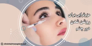 مزوتراپی برای درمان سیاهی دور چشم
