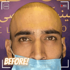معایب کاشت مو به روش fit