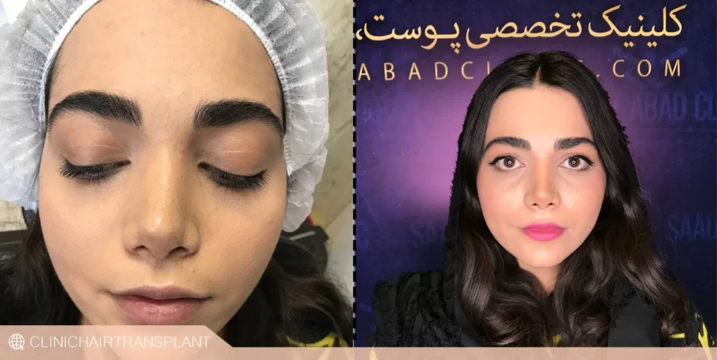 کاشت ابرو بدون جراحی