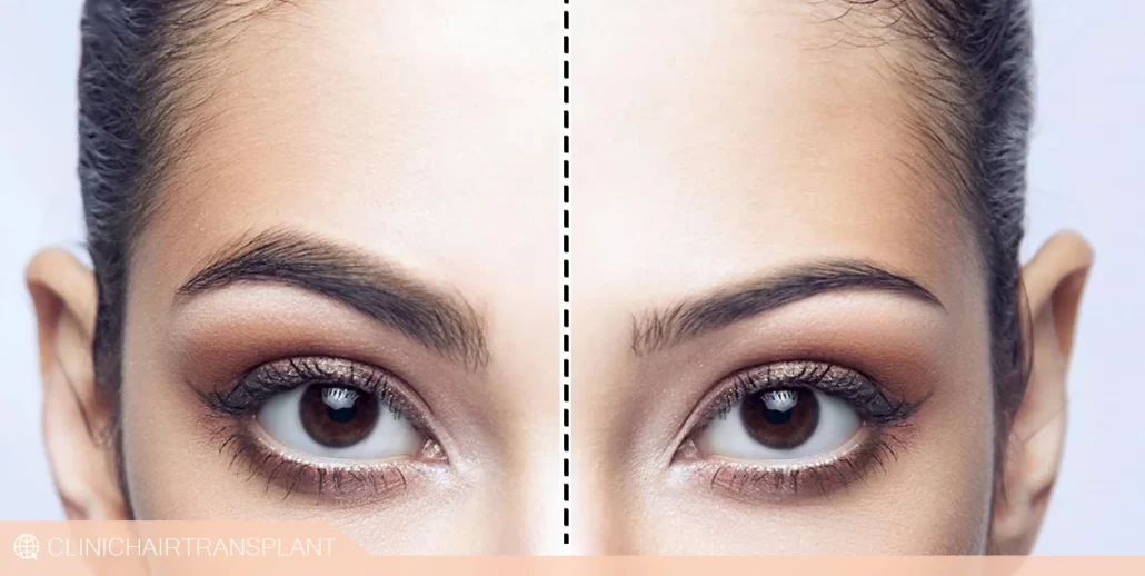 کاشت ابرو fut چقدر هزینه دراد؟