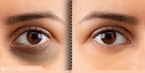 درمان سیاهی دور چشم با مزوتراپی