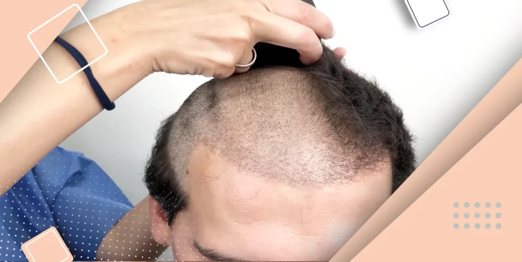 مهمترین معایب کاشت مو به روش fit