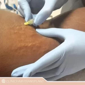 رفع ترک پوستی با کربوکسی تراپی