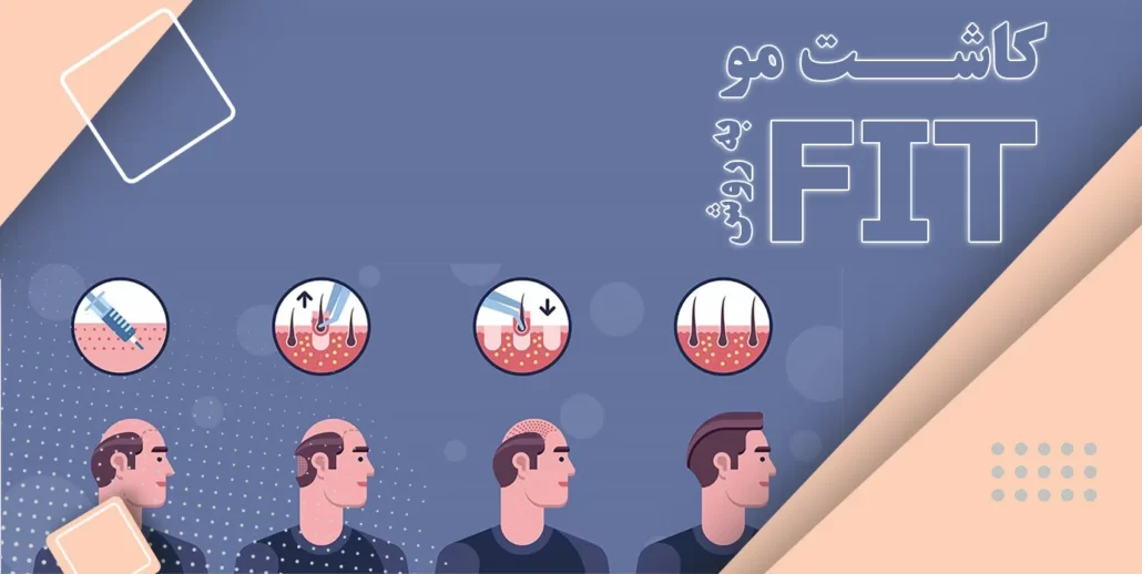 هزینه و قیمت کاشت مو به روش fit