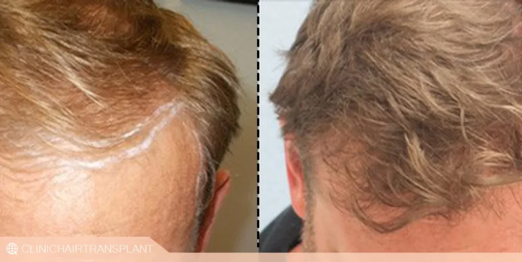 قبل و بعد کاشت مو به روش fit