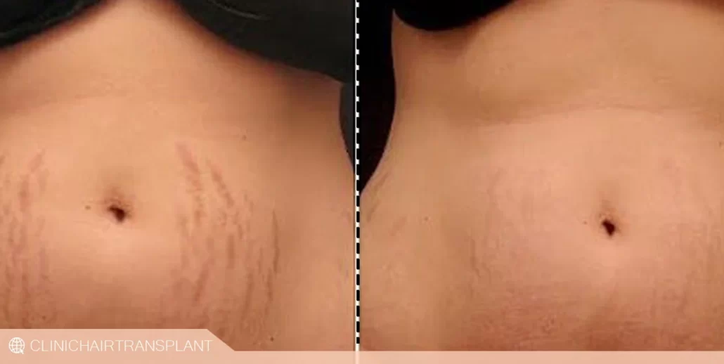 قبل و بعد کربوکسی تراپی برای ترک پوستی