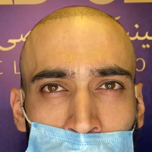 قبل از کاشتن مو