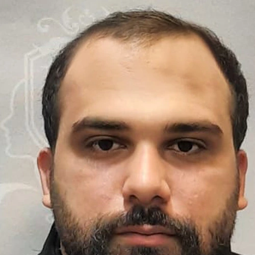 قبل از کاشت مو