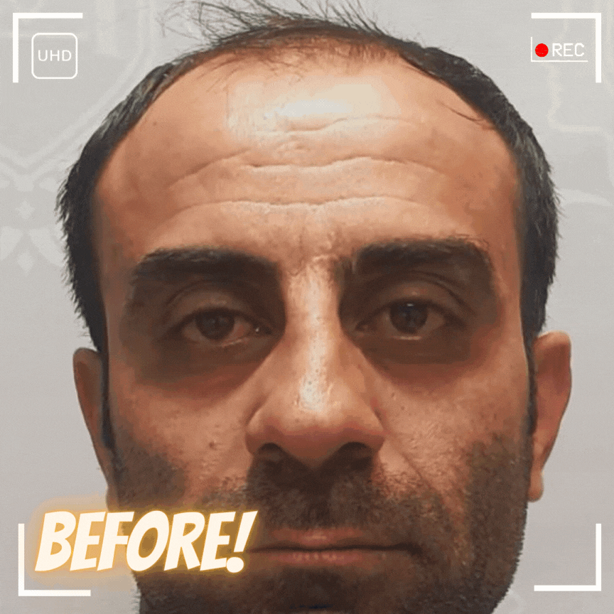قبل و بعد درمان ریزش موی ارثی