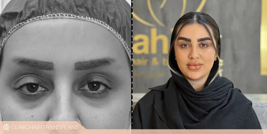 قبل و بعد کاشت ابرو در یک جلسه
