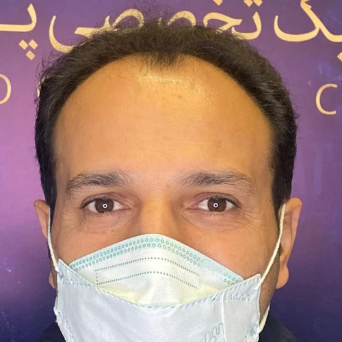 قبل کاشت موی