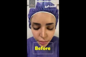 و-بعد-کاشت-ابرو-poster