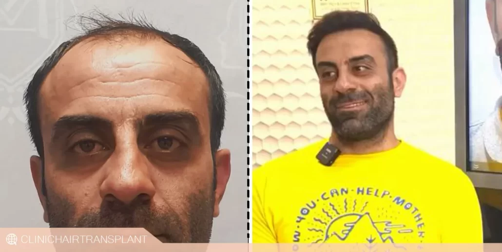 قبل و بعد از کاشت مو