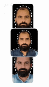 قبل و بعد کاشت موی سر