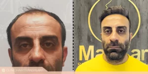 قبل و بعد کاشت مو - مزوتراپی چه تاثیری دارد؟
