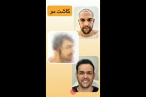 کاشت-مو-قبل-و-بعد-poster